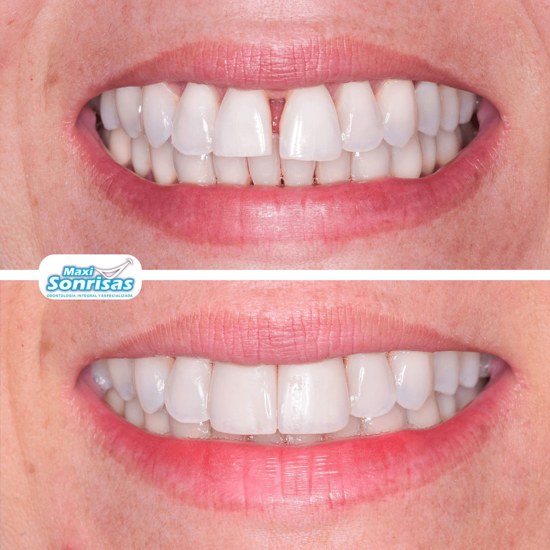 01. Antes y Despues